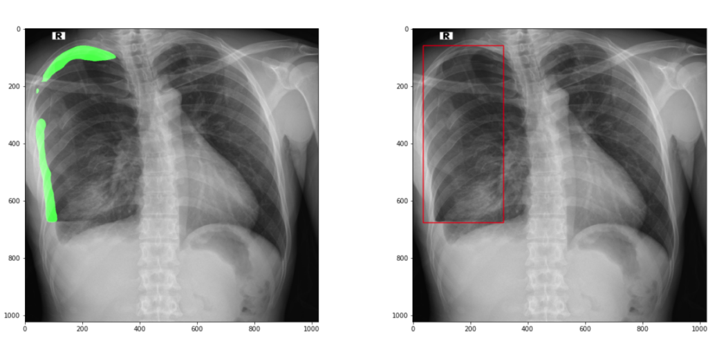 Сравнение рентген-снимков с обнаруженным пневмотораксом 